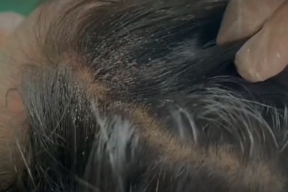 Женщина показала тысячи вшей в волосах 90-летней клиентки